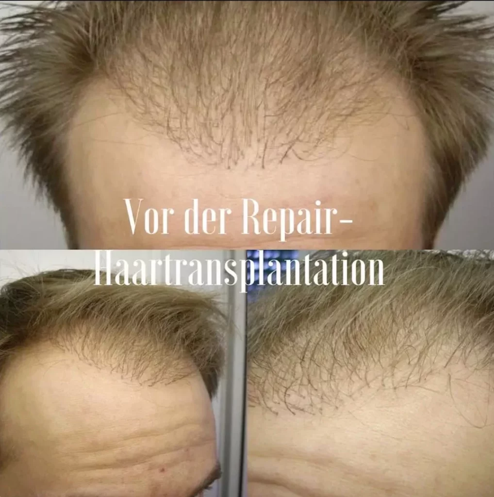 Marco`s misslungene Haartransplantation - OP Pfusch in Deutschland par Excellence