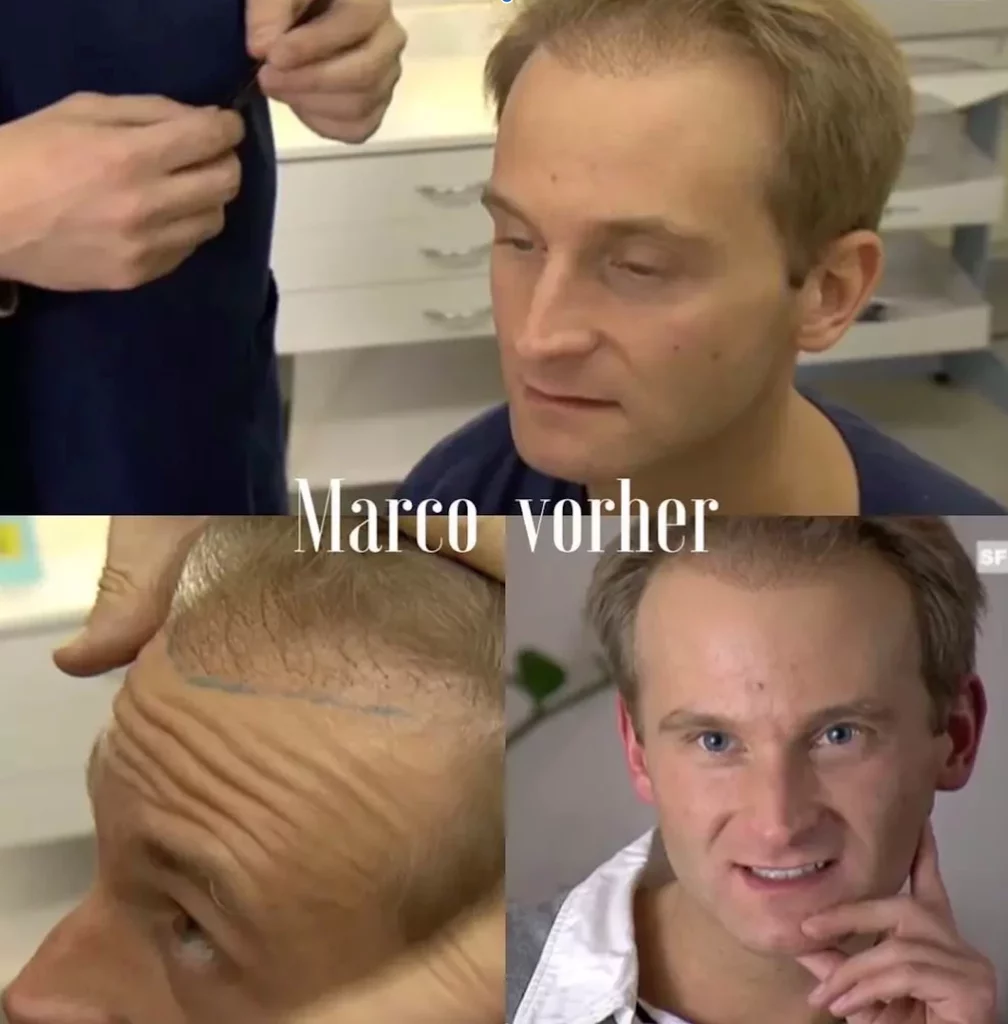 Marco nach verpfuschte Haartransplantation in Deutschland und vor der Pfusch-Korrektur